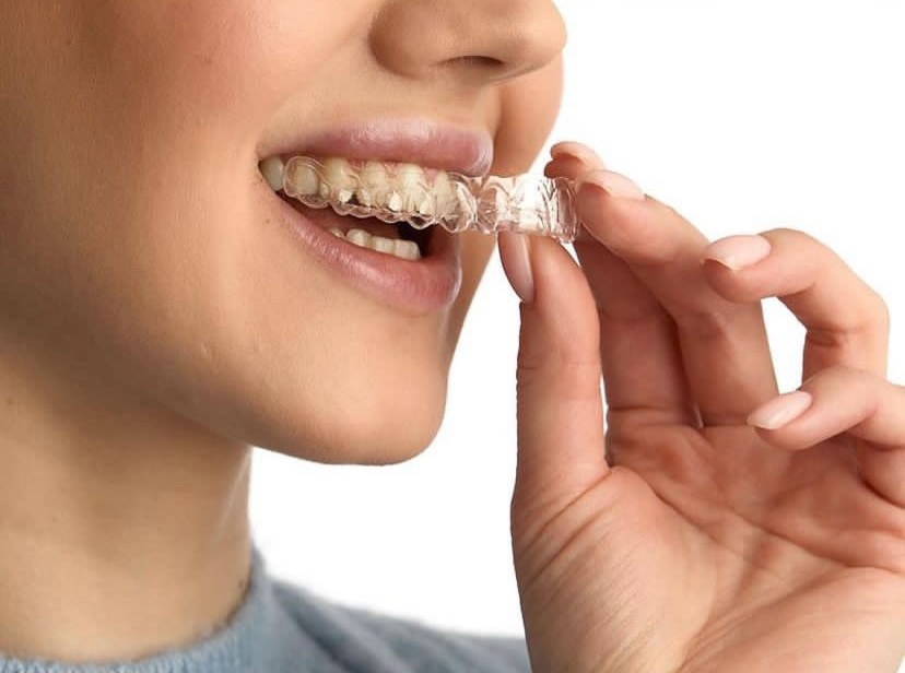 В Dental Forte развивают новую для РТ цифровую методику коррекции без брекетов