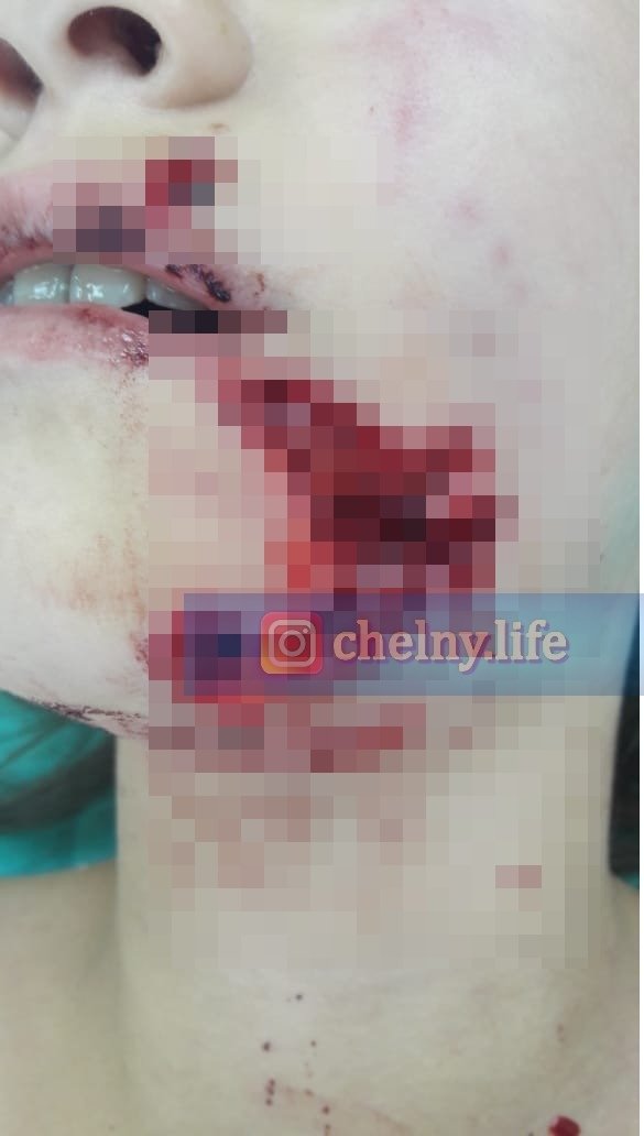В Челнах собака разорвала лицо ребенку. Инцидент проверит прокуратура