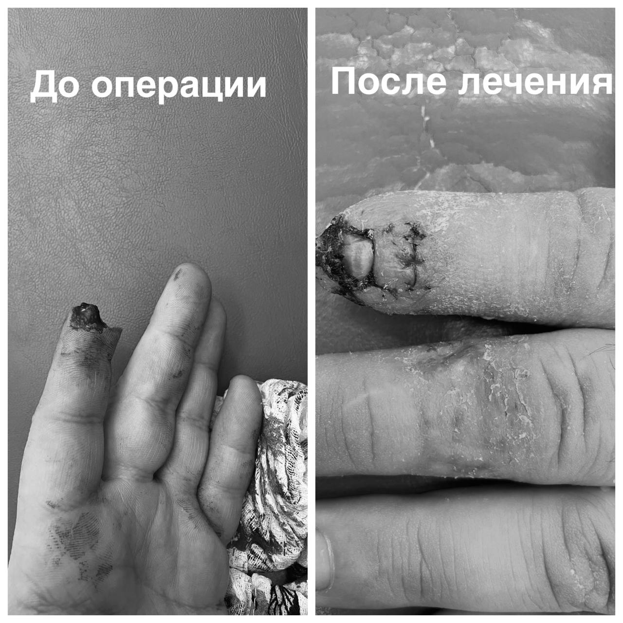 В БСМП спасли мужчине палец, оторванный цепью снегохода (шок-фото)