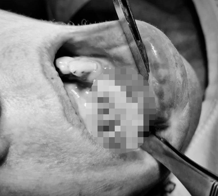 Челнинские хирурги заменили 45-летней женщине сгнившую челюсть 