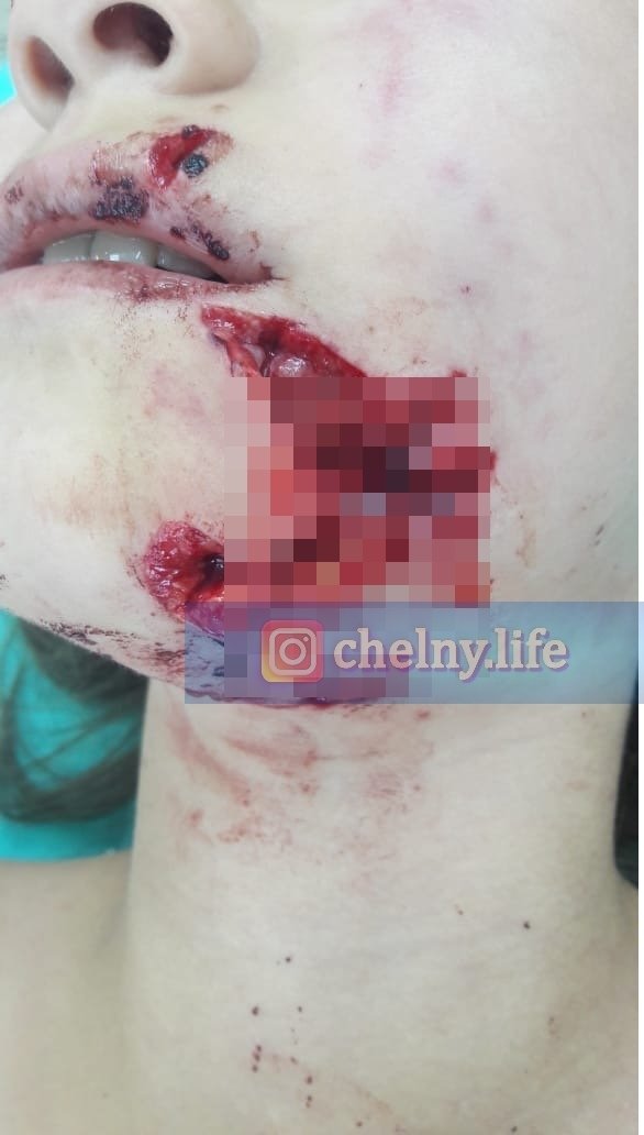 В Челнах собака разорвала лицо ребенку. Инцидент проверит прокуратура