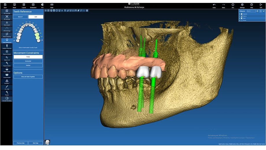 Хирург-имплантолог  совместно с зубным техником проводят цифровое планирование имплантации