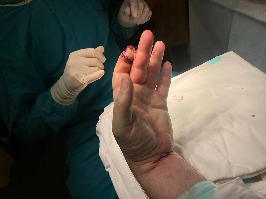 В БСМП спасли мужчине палец, оторванный цепью снегохода (шок-фото)