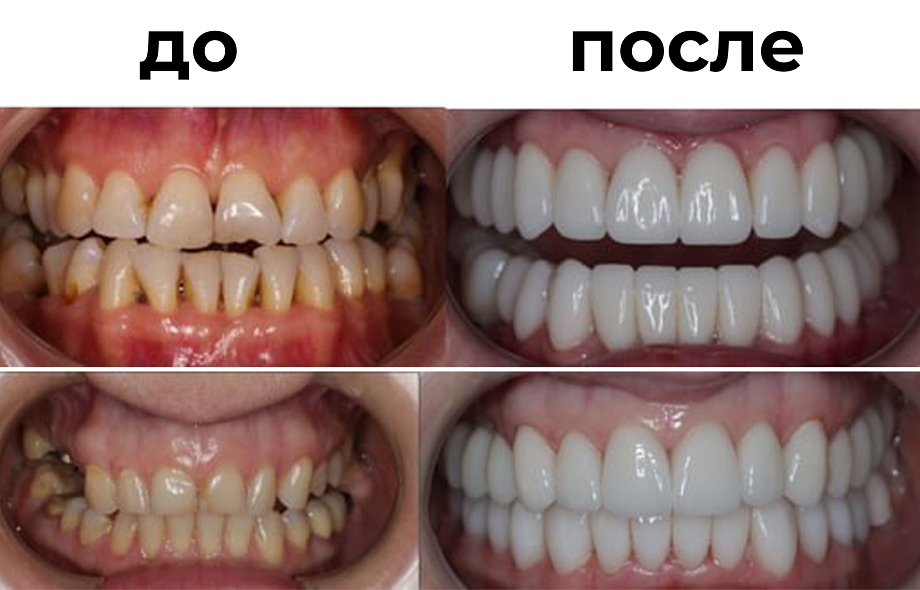  Все о керамических винирах: как идеальная улыбка преображает жизнь и дает уверенность в себе