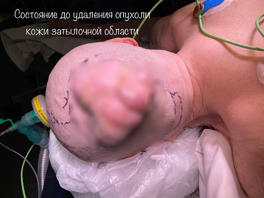 Хирурги БСМП удалили пенсионерке огромную опухоль с черепа (фото)